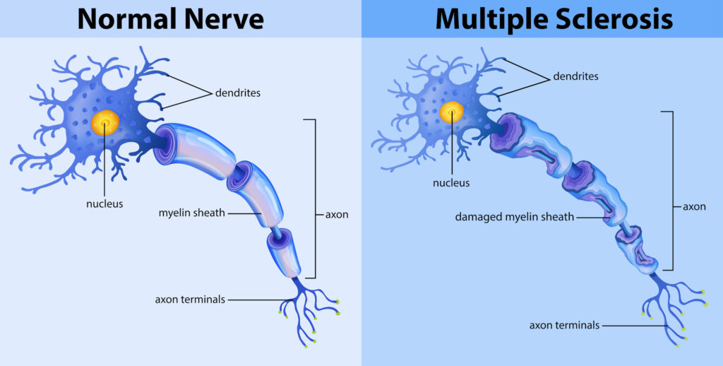 Normal nerve and multiple sclerosis illustration